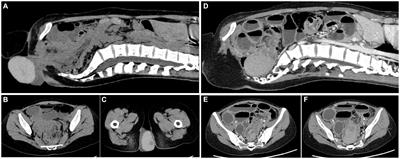 A case report of a giant ileocecal cystic prolapse through the anus and literature review